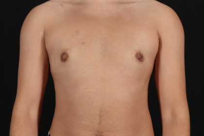 FTM Chest Contouring Before & After Patient #4694