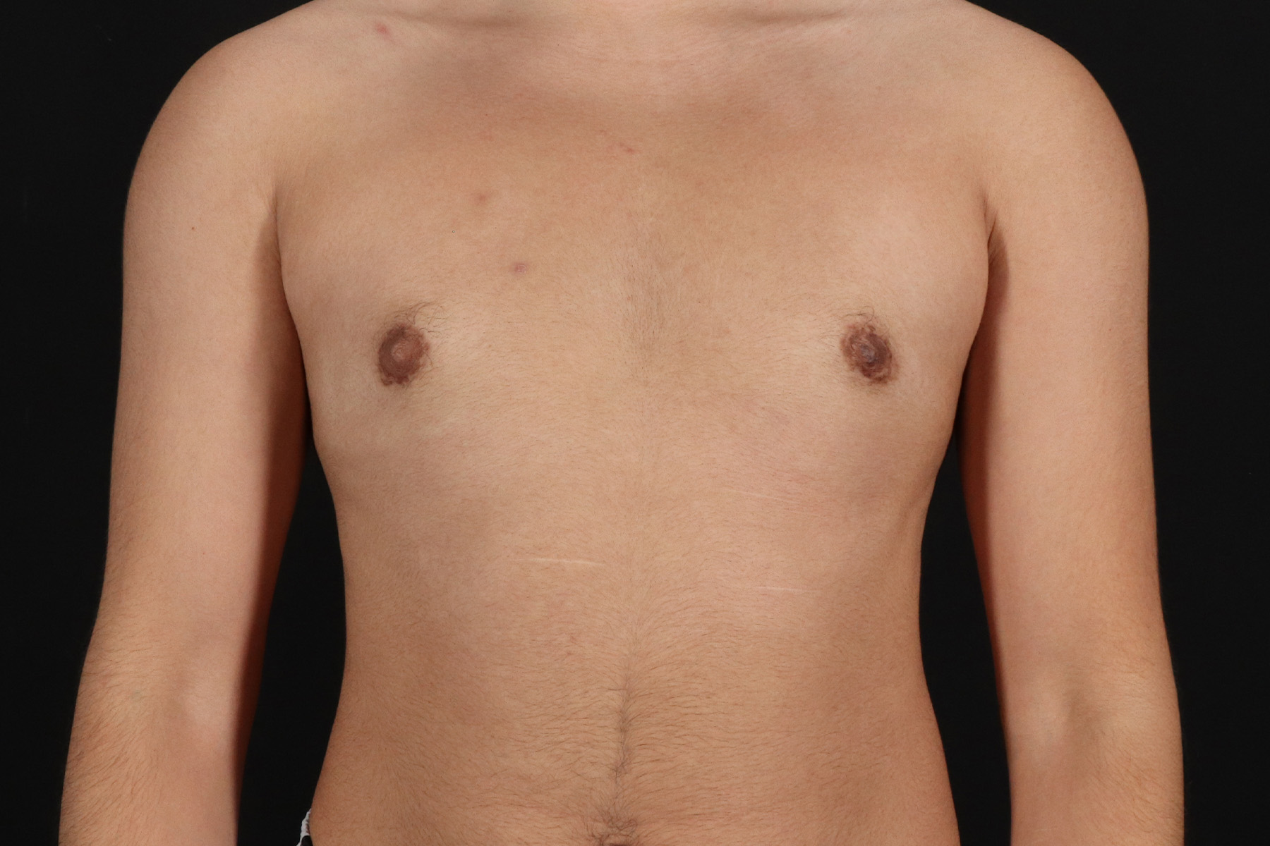 FTM Chest Contouring Before & After Patient #4694
