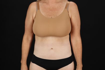 Circumferential Body Lift Before & After Patient #4500