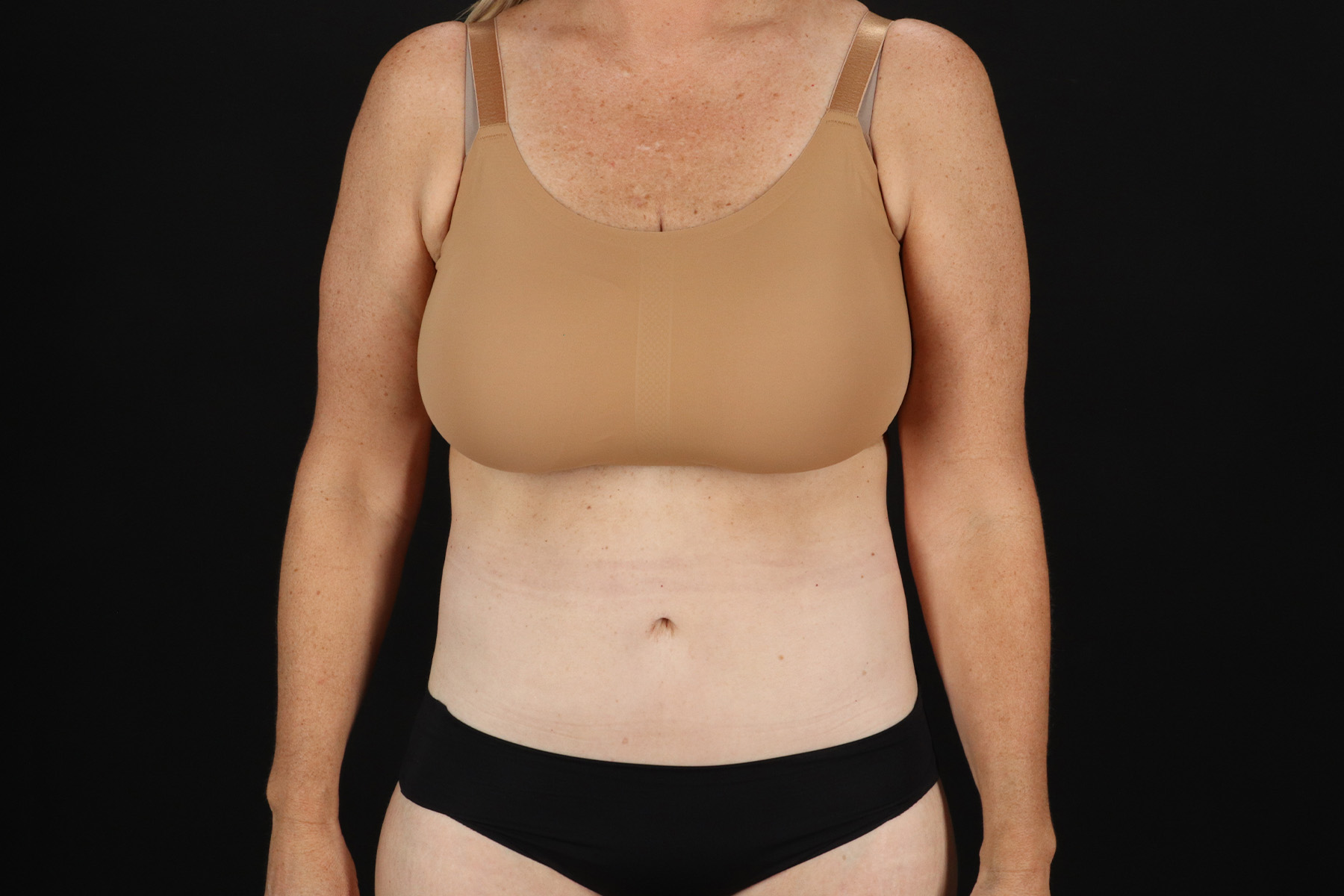 Circumferential Body Lift Before & After Patient #4500