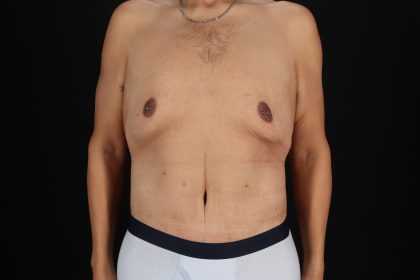 Circumferential Body Lift Before & After Patient #4497