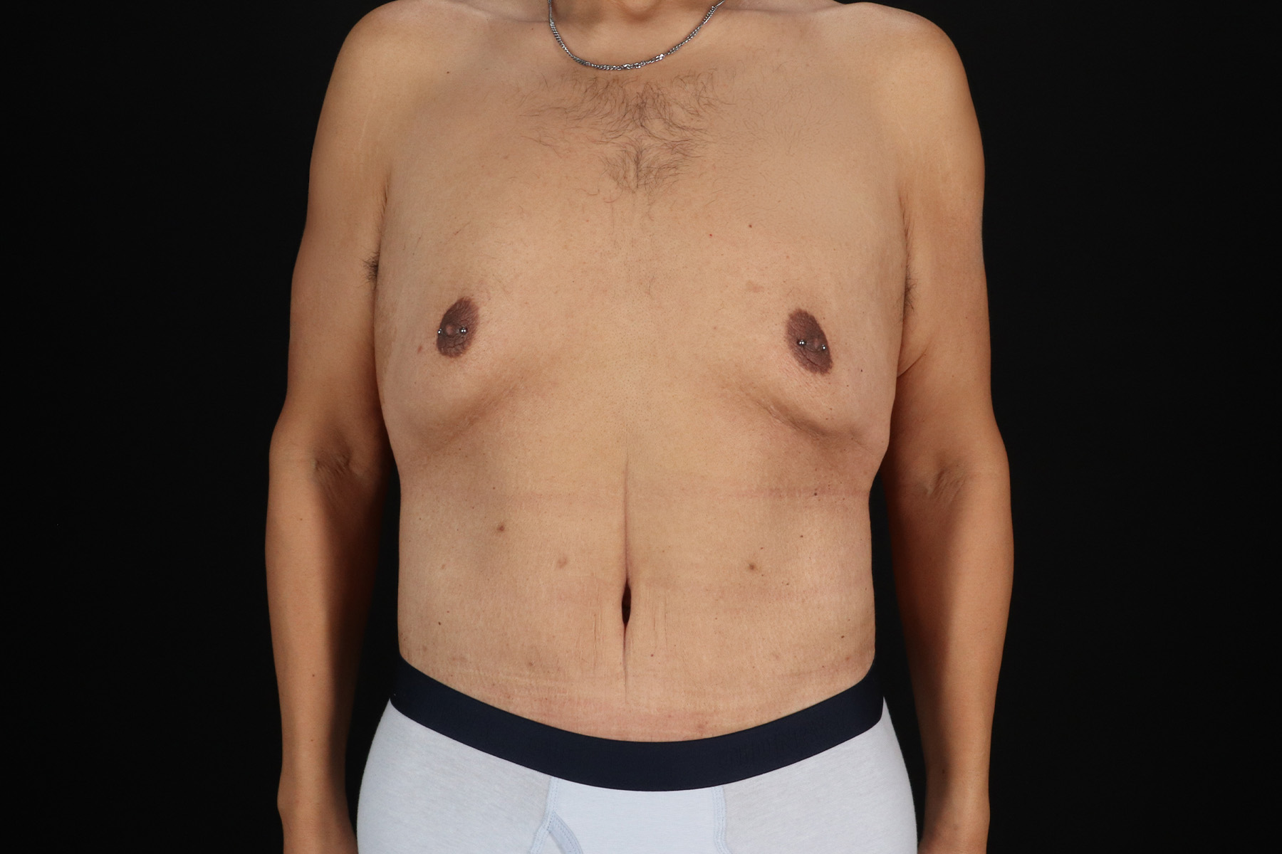 Circumferential Body Lift Before & After Patient #4497
