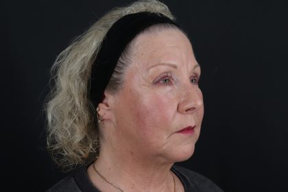 Face & Neck Lift Before & After Patient #4693