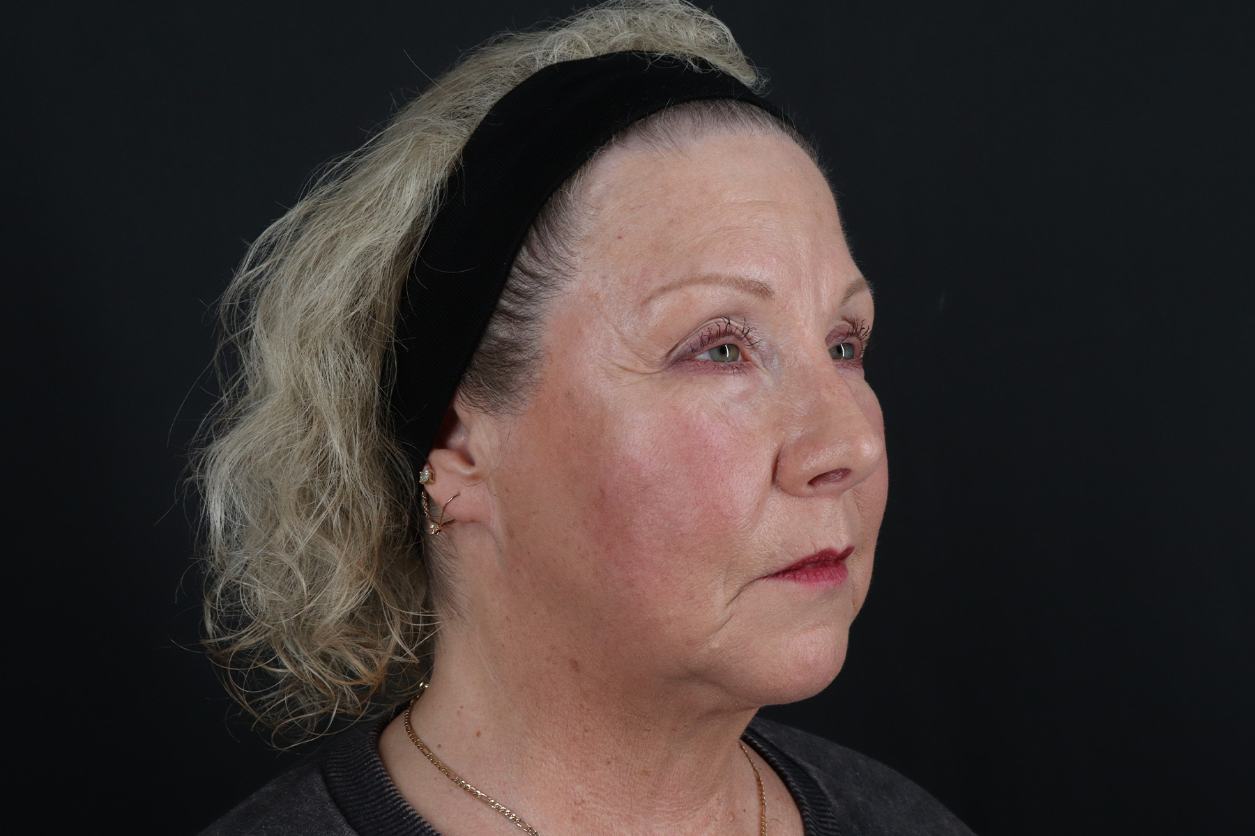 Face & Neck Lift Before & After Patient #4693