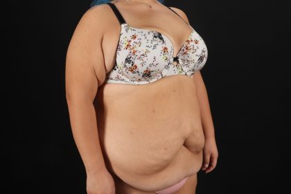Circumferential Body Lift Before & After Patient #4499