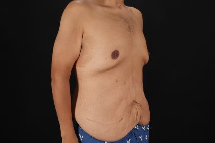 Circumferential Body Lift Before & After Patient #4497