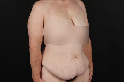 Circumferential Body Lift Before & After Patient #4490