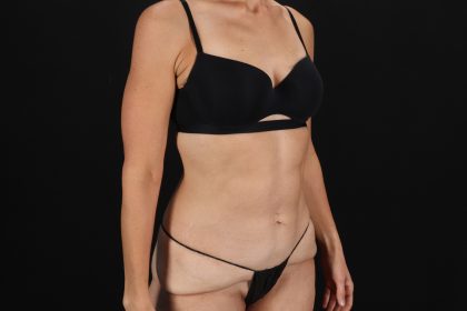Circumferential Body Lift Before & After Patient #4493