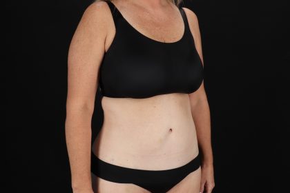 Circumferential Body Lift Before & After Patient #4500