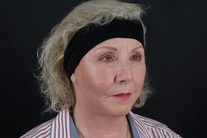 Face & Neck Lift Before & After Patient #4693