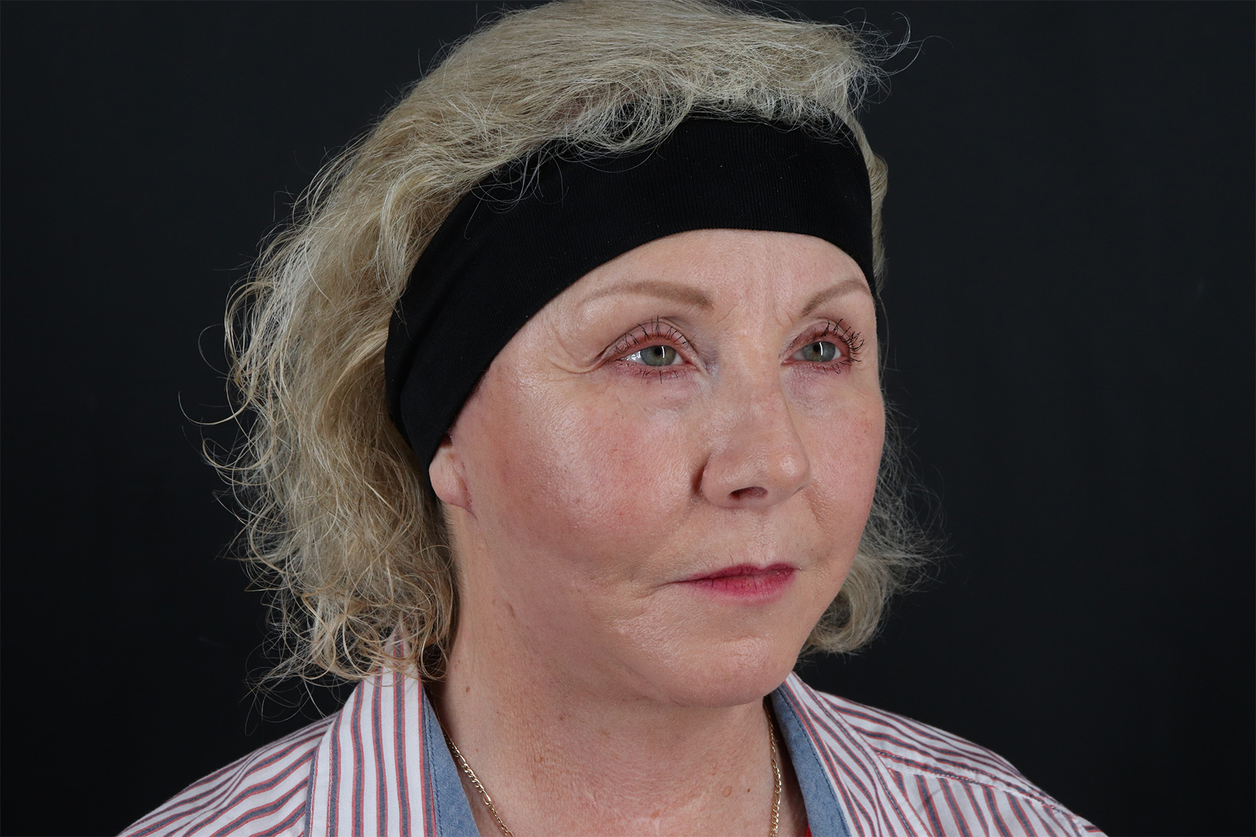 Face & Neck Lift Before & After Patient #4693