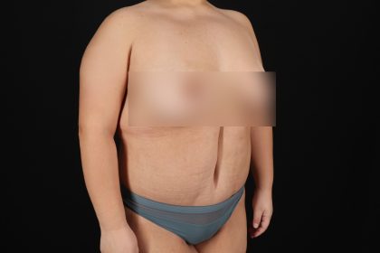 Circumferential Body Lift Before & After Patient #4499