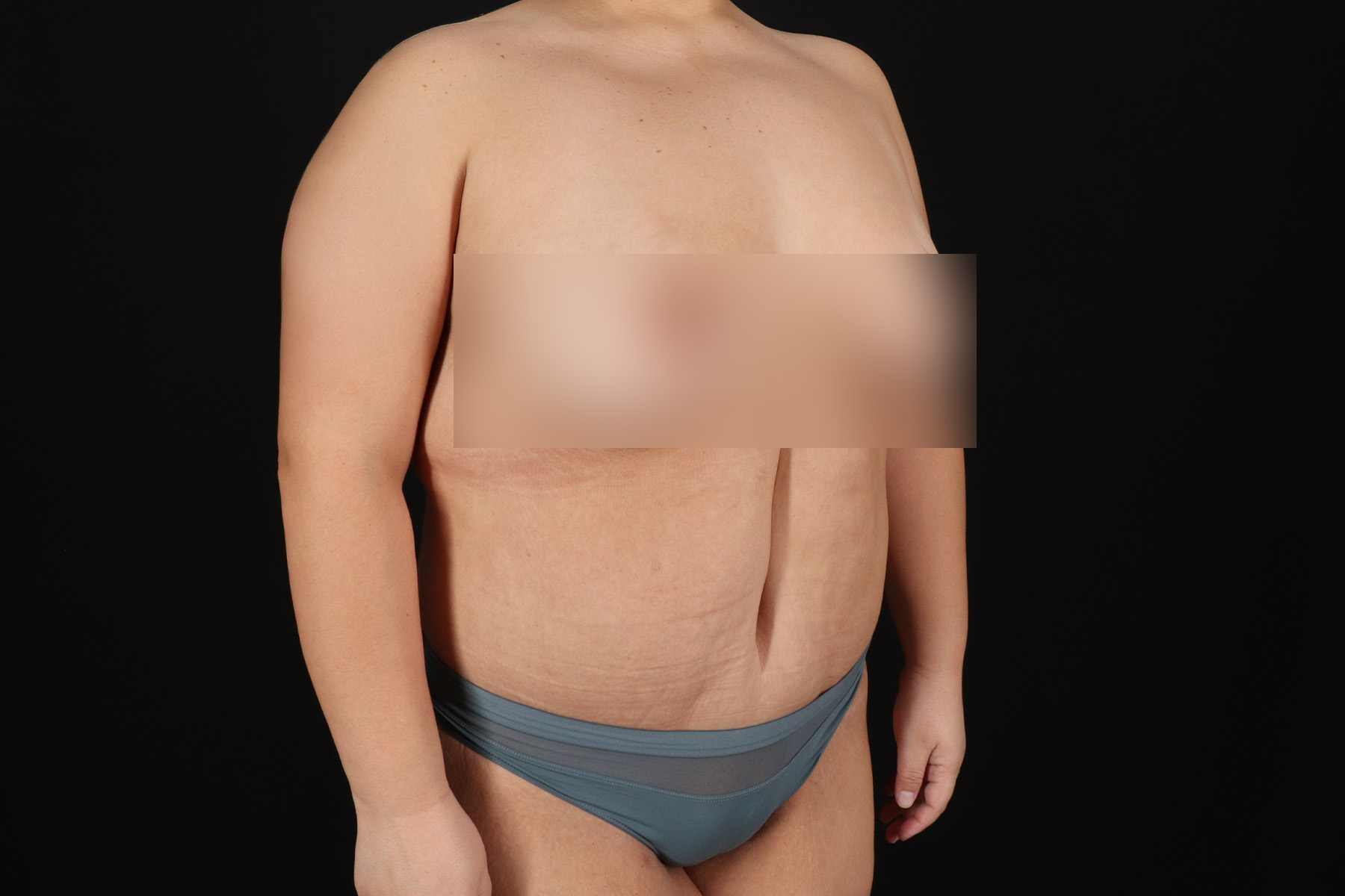 Circumferential Body Lift Before & After Patient #4499