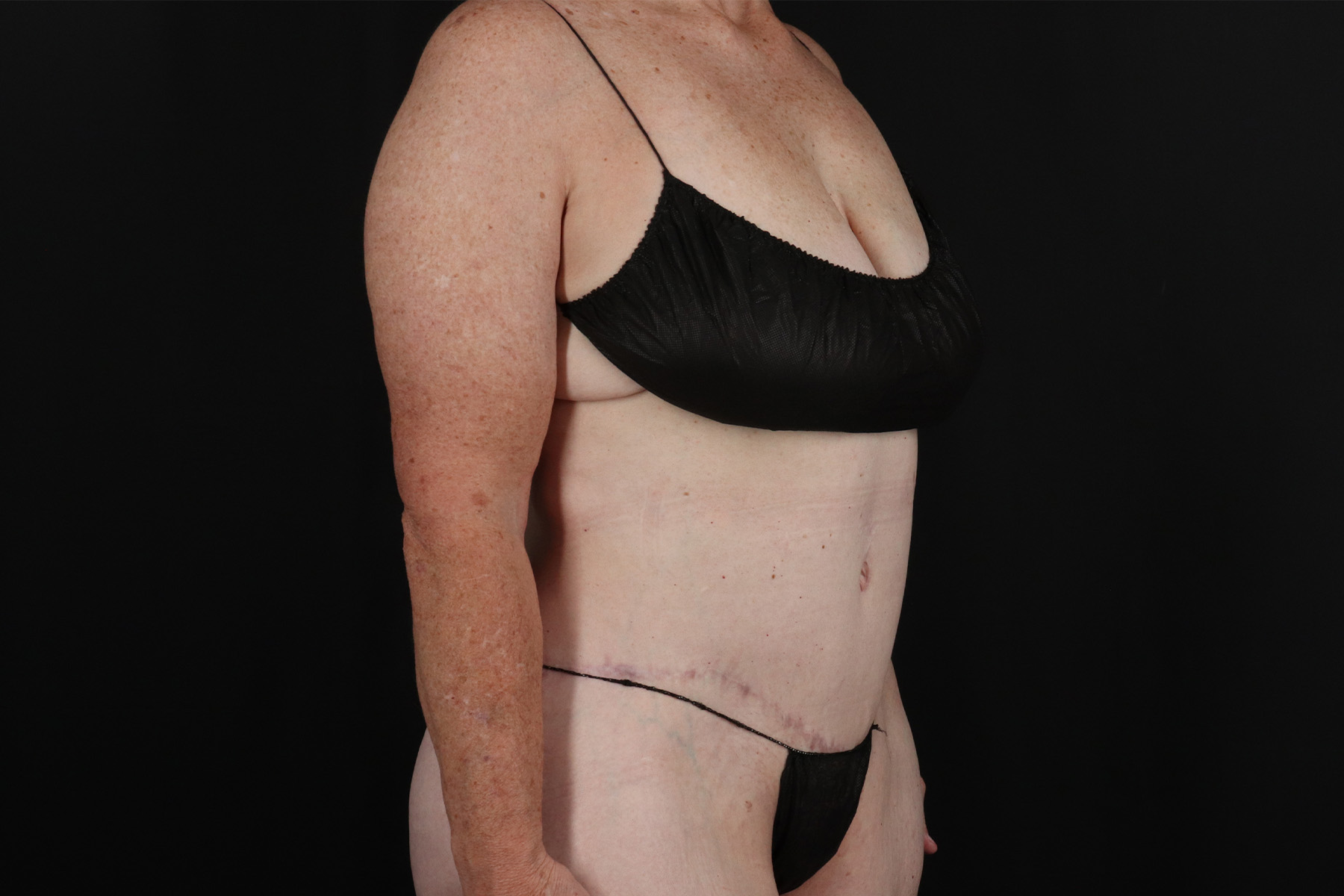 Circumferential Body Lift Before & After Patient #4490