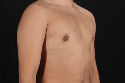 FTM Chest Contouring Before & After Patient #4694