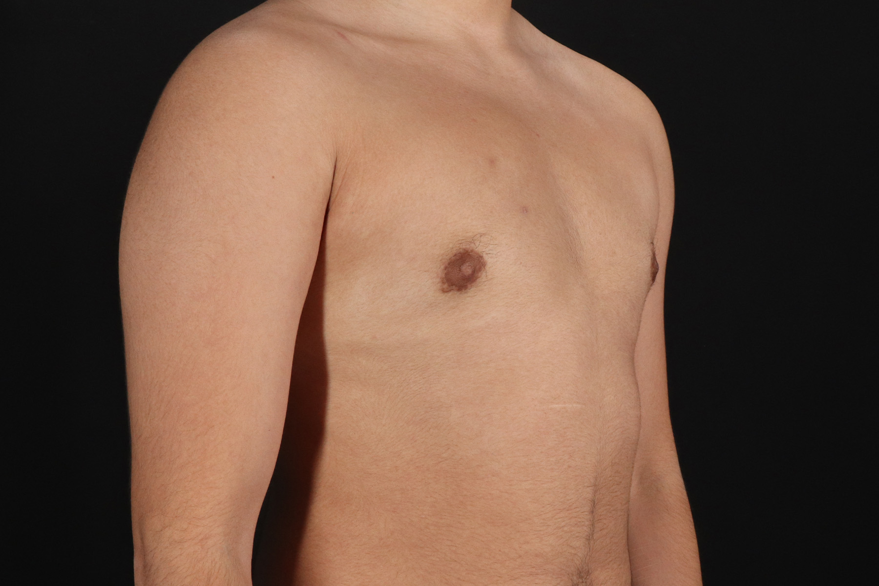 FTM Chest Contouring Before & After Patient #4694
