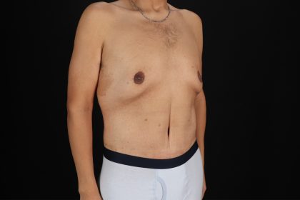 Circumferential Body Lift Before & After Patient #4497