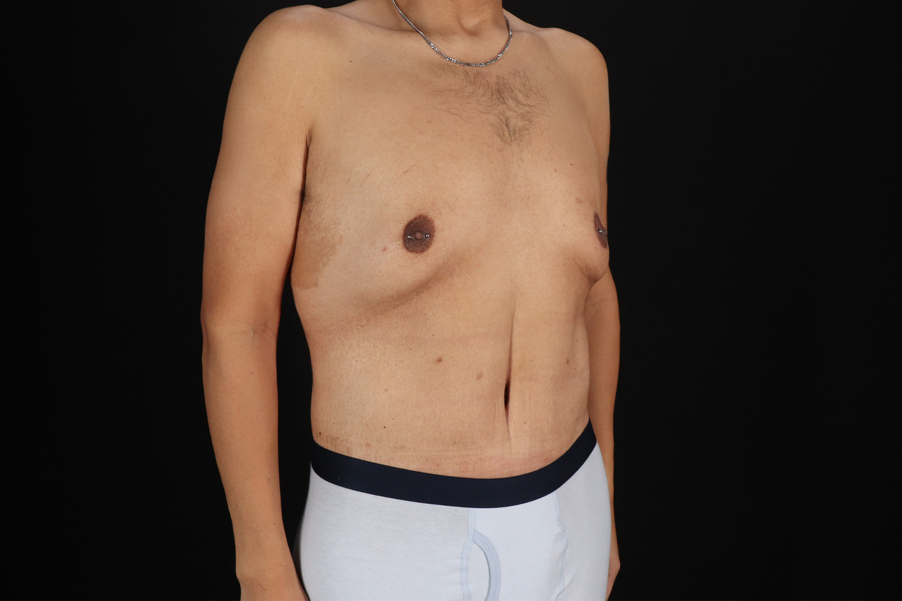 Circumferential Body Lift Before & After Patient #4497