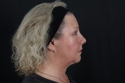 Face & Neck Lift Before & After Patient #4693