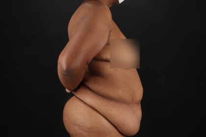 Circumferential Body Lift Before & After Patient #4494