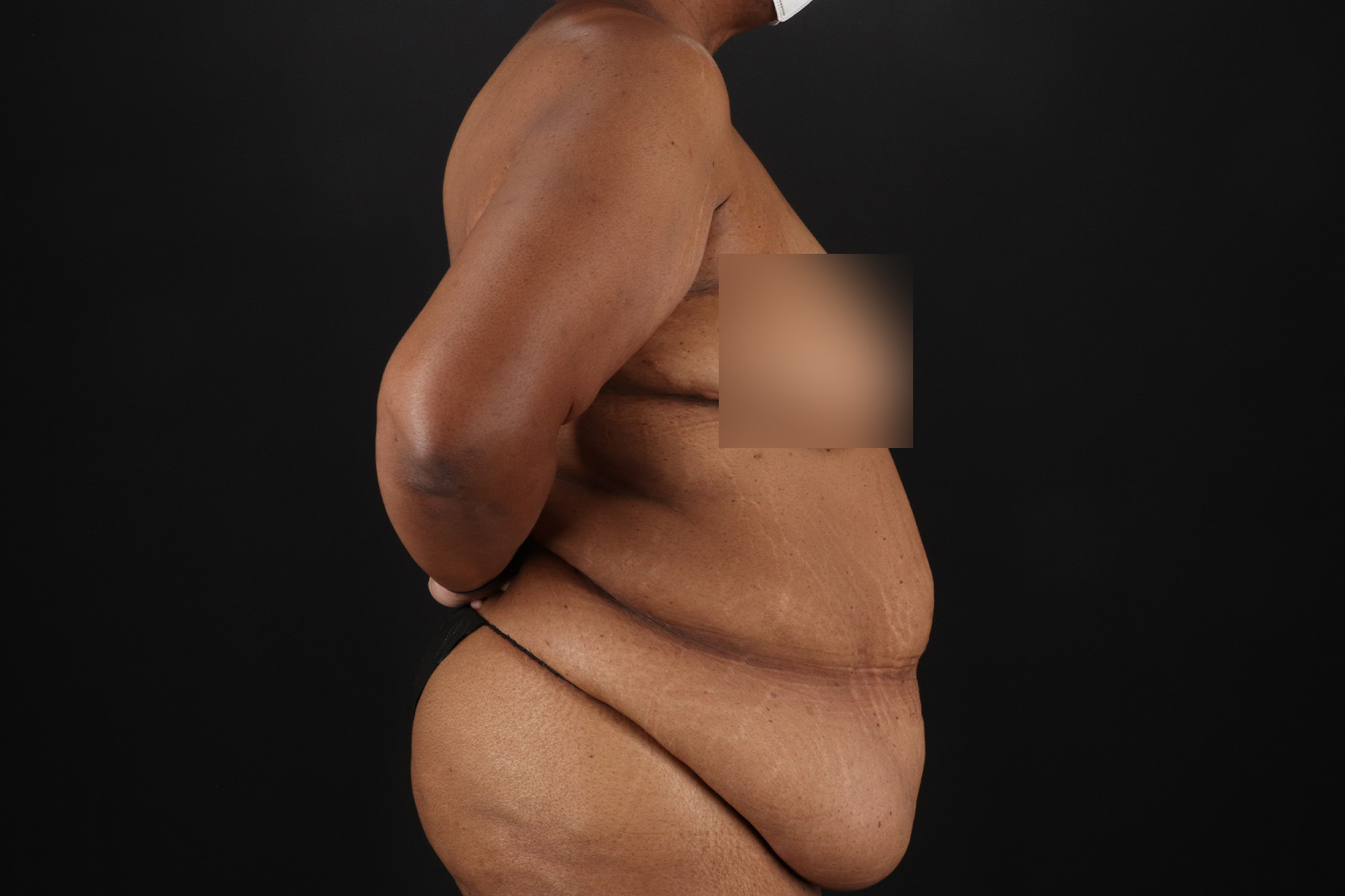 Circumferential Body Lift Before & After Patient #4494