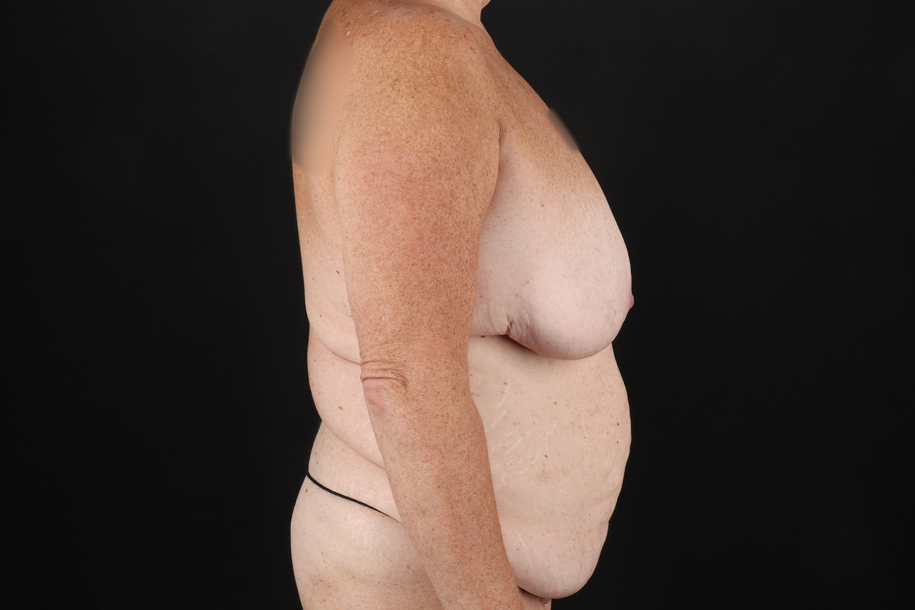 Circumferential Body Lift Before & After Patient #4496