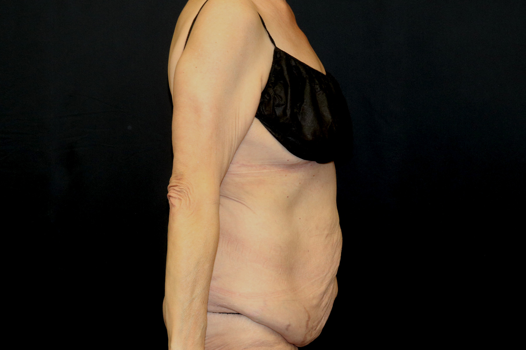 Circumferential Body Lift Before & After Patient #4495