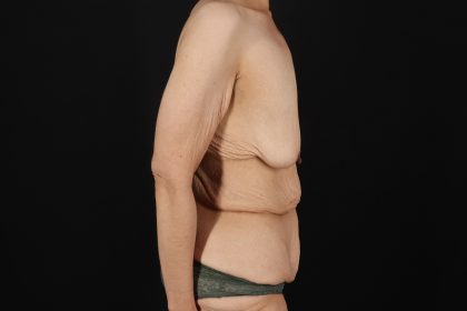 Circumferential Body Lift Before & After Patient #4489