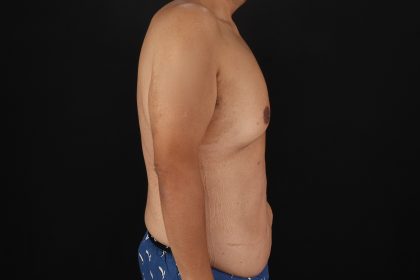 Circumferential Body Lift Before & After Patient #4497