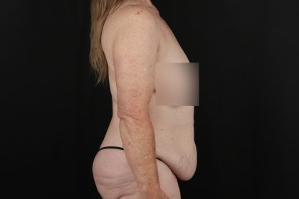Circumferential Body Lift Before & After Patient #4490