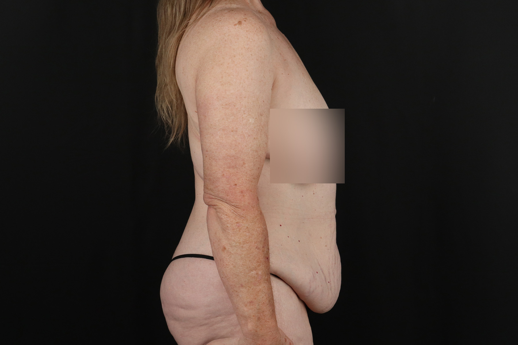 Circumferential Body Lift Before & After Patient #4490