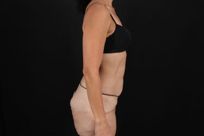 Circumferential Body Lift Before & After Patient #4493