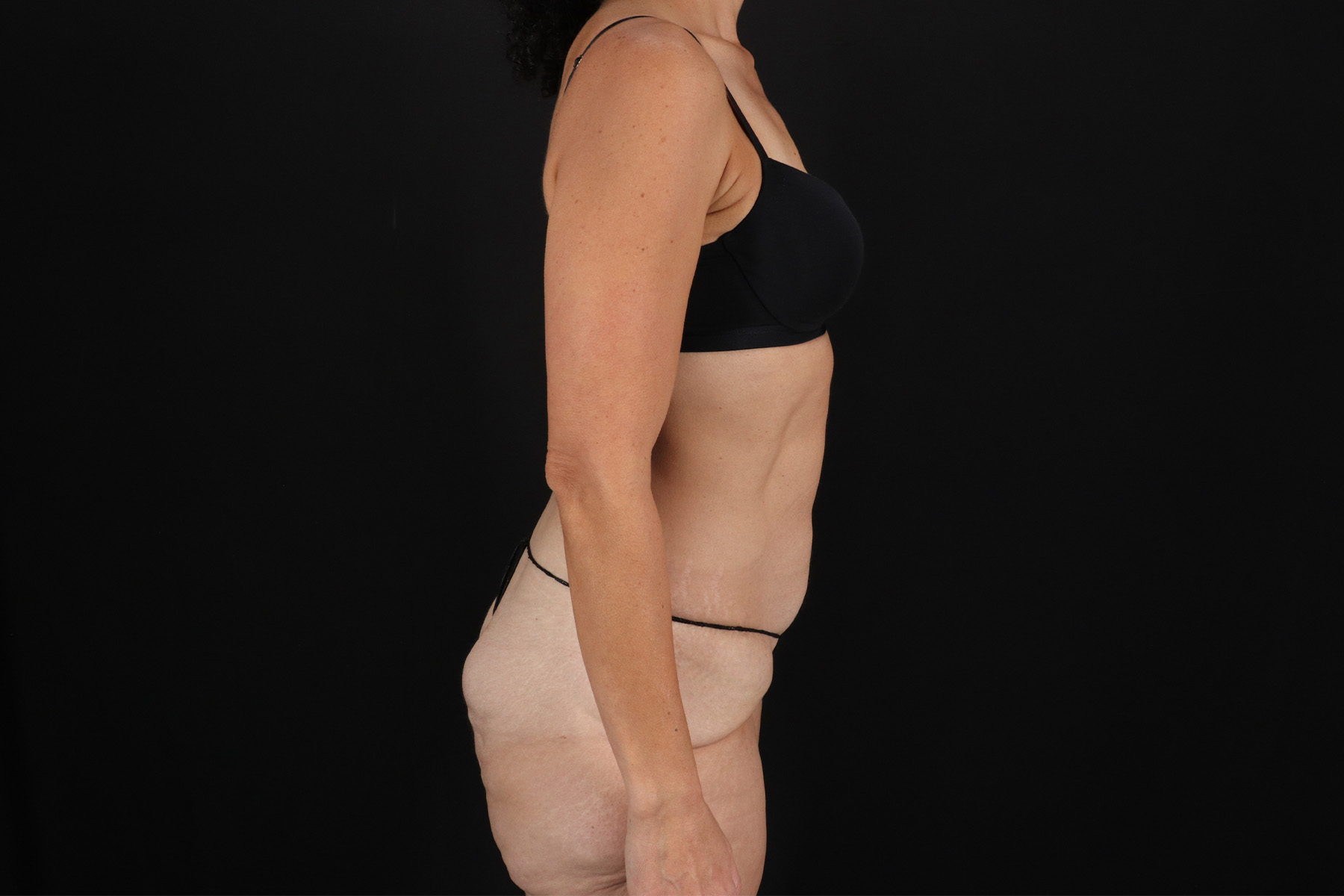Circumferential Body Lift Before & After Patient #4493