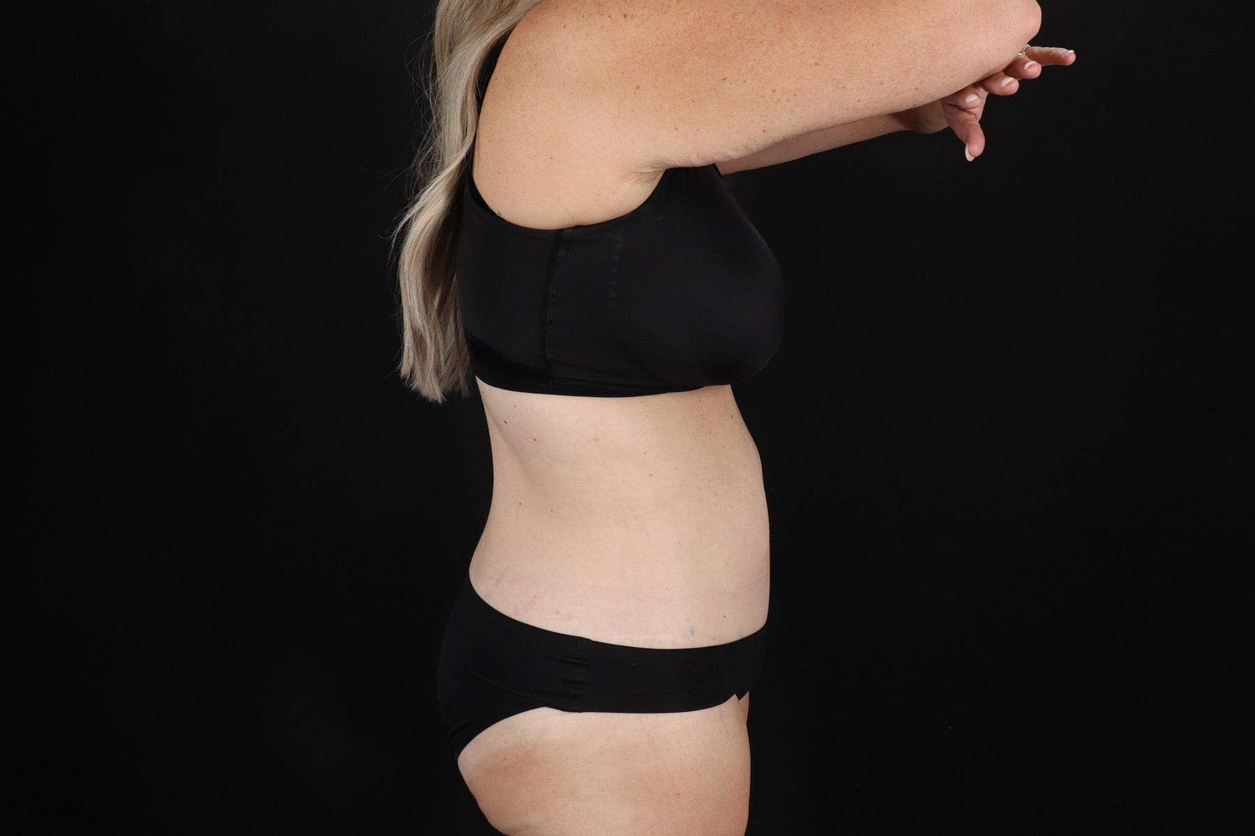 Circumferential Body Lift Before & After Patient #4500