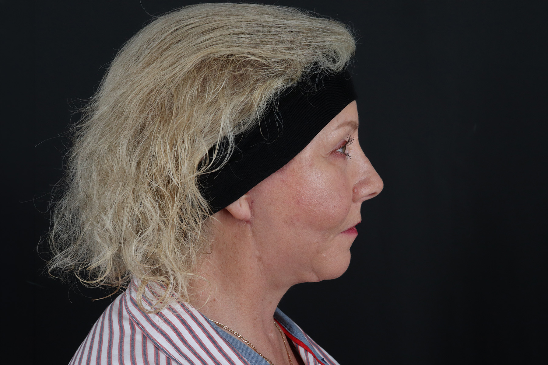 Face & Neck Lift Before & After Patient #4693