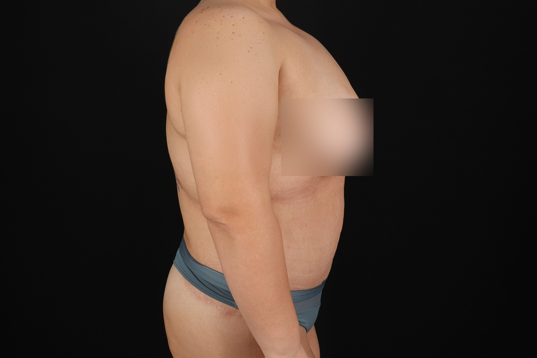Circumferential Body Lift Before & After Patient #4499