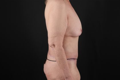 Circumferential Body Lift Before & After Patient #4504