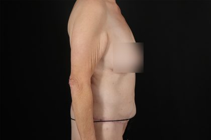 Circumferential Body Lift Before & After Patient #4495