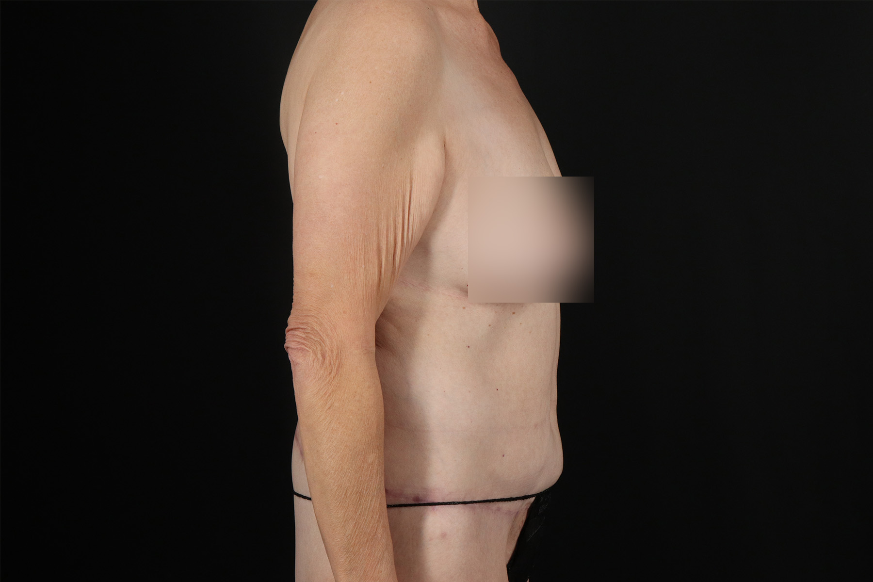 Circumferential Body Lift Before & After Patient #4495