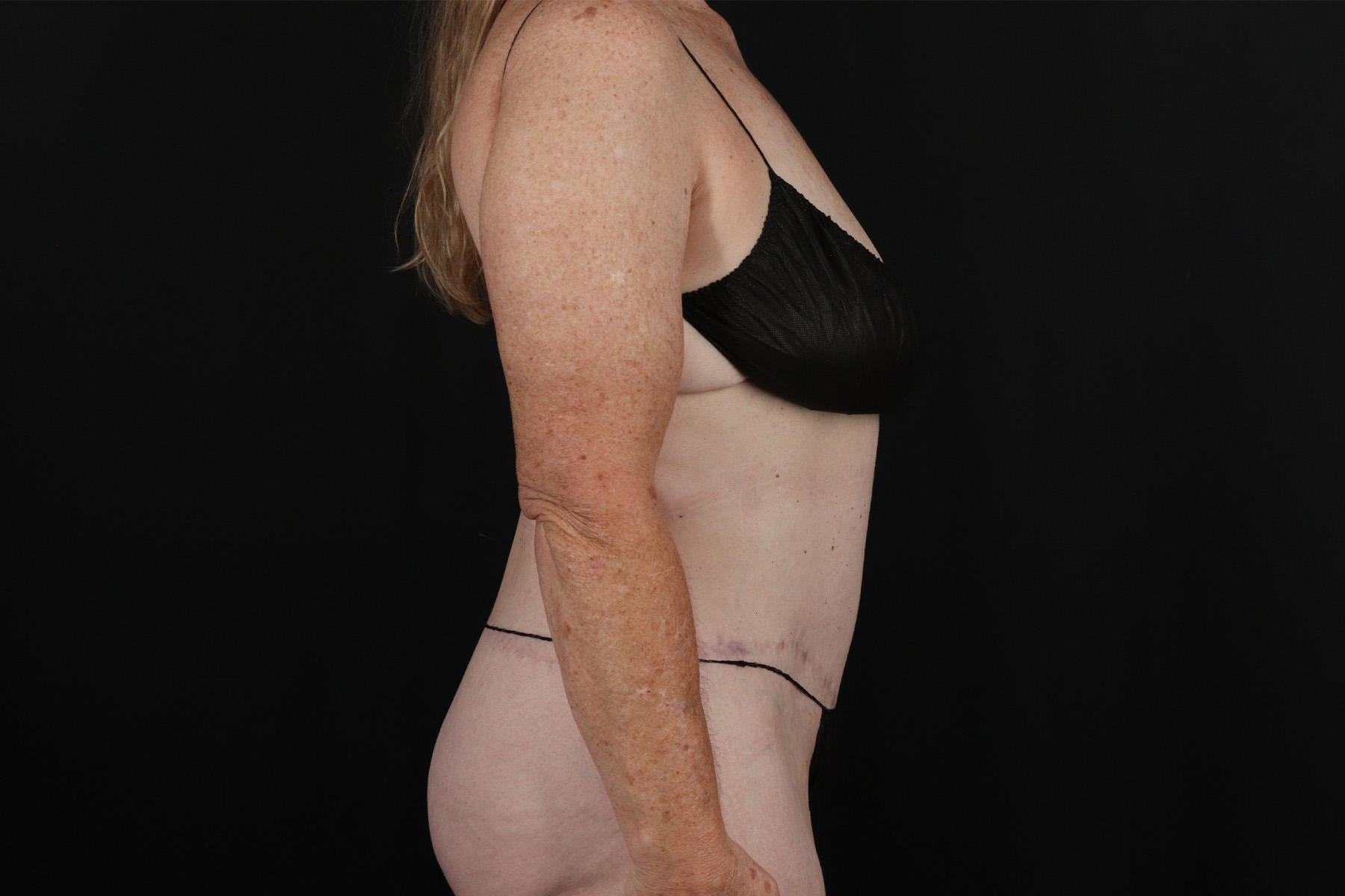 Circumferential Body Lift Before & After Patient #4490