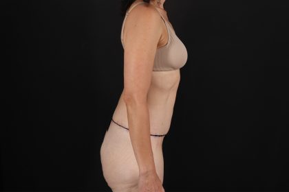 Circumferential Body Lift Before & After Patient #4493