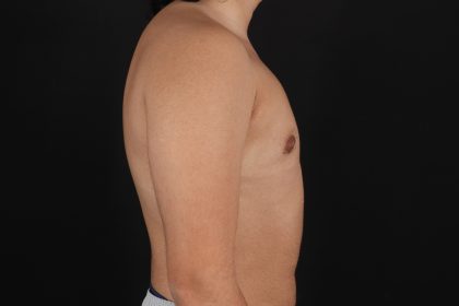 FTM Chest Contouring Before & After Patient #4694