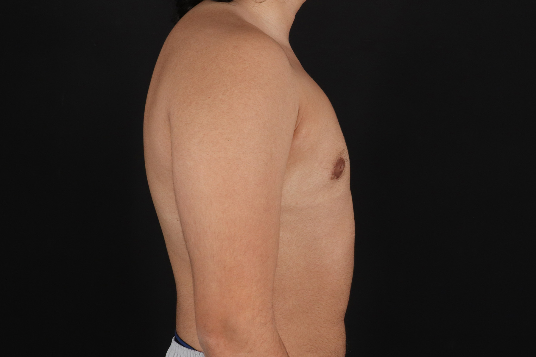 FTM Chest Contouring Before & After Patient #4694