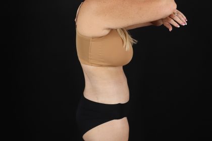 Circumferential Body Lift Before & After Patient #4500