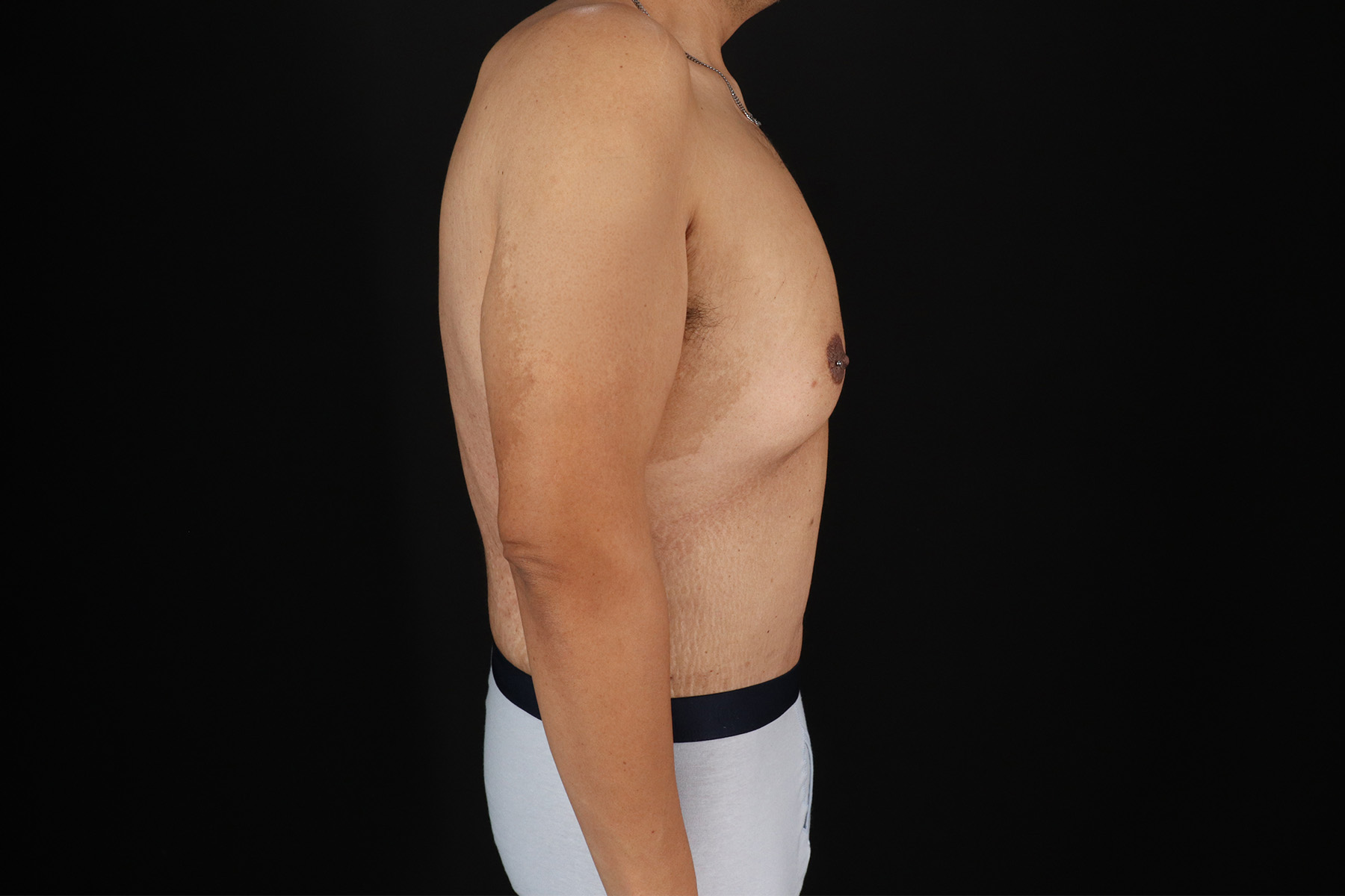Circumferential Body Lift Before & After Patient #4497