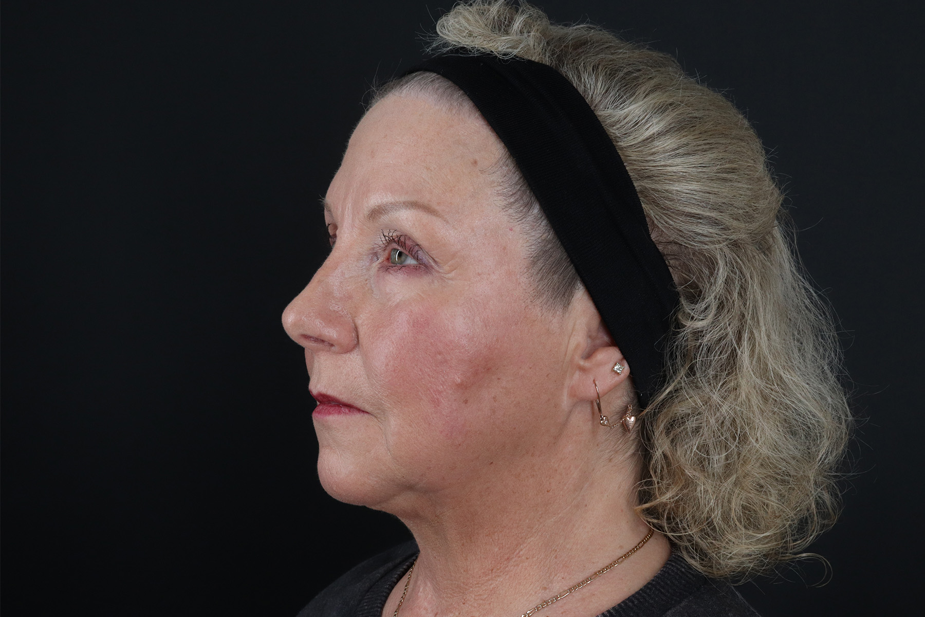 Face & Neck Lift Before & After Patient #4693