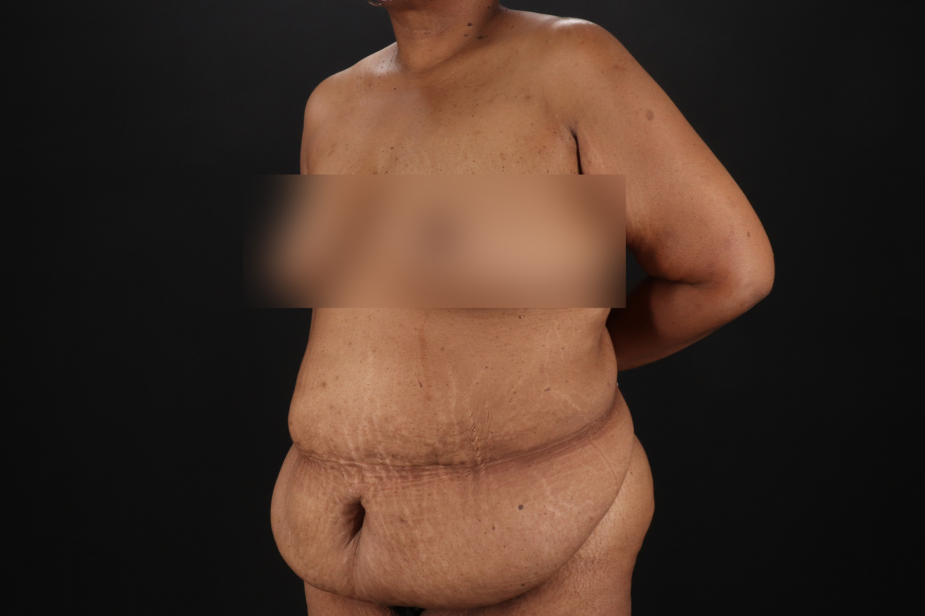 Circumferential Body Lift Before & After Patient #4494