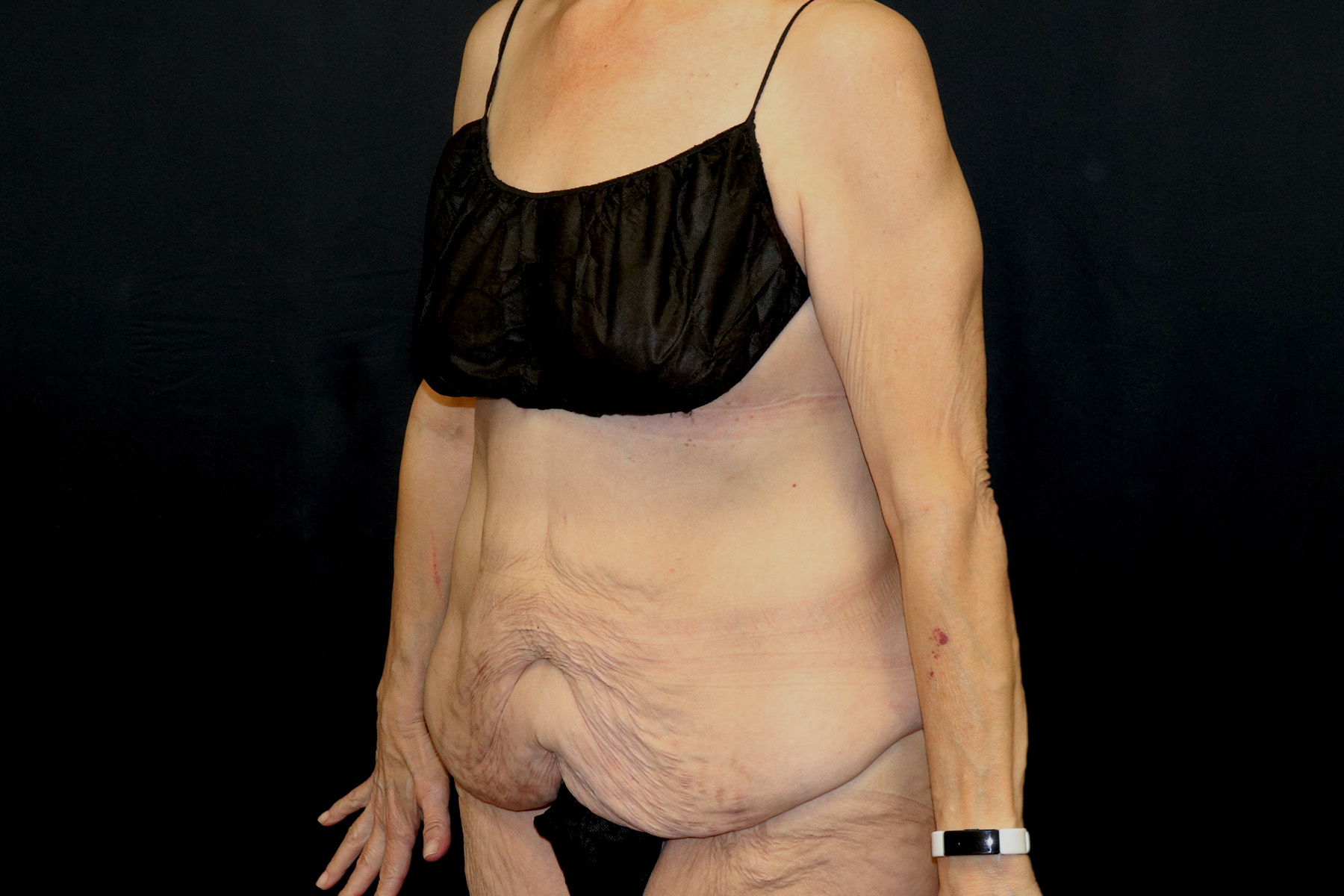 Circumferential Body Lift Before & After Patient #4495