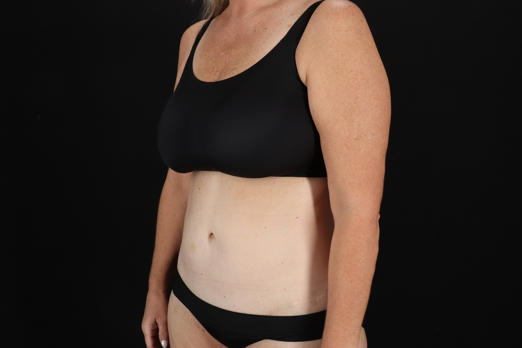 Circumferential Body Lift Before & After Patient #4500