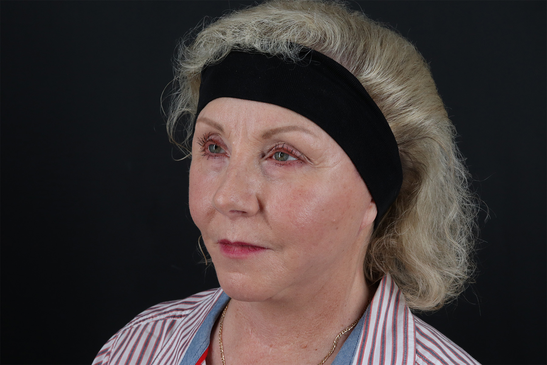 Face & Neck Lift Before & After Patient #4693